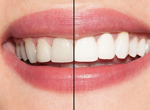 closeup of before and after teeth whitening smile