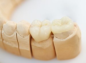 all-ceramic dental crowns on teeth model