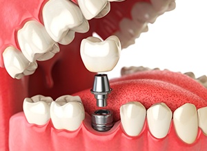 Fairfield dental implants model