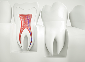 Fairfield root canals model