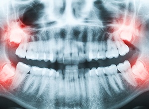 Fairfield wisdom teeth extractions panoramic x-ray